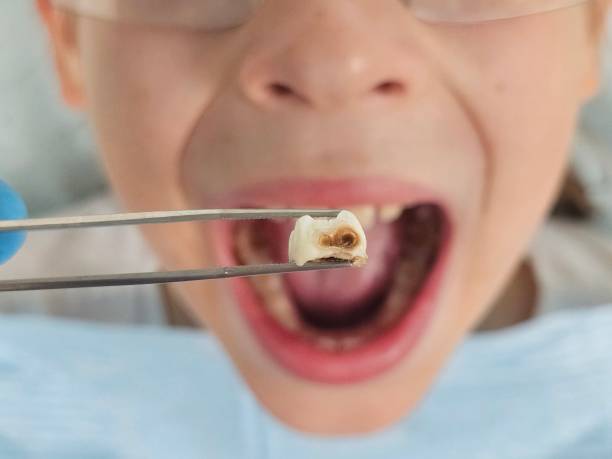 Best Emergency Wisdom Teeth Removal in Kiawah Island, SC